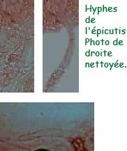 Hyphe de l'épicutis.jpg